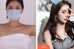 成都市第三人民医院医学整形美容科梁静萍整形价格表附手臂吸脂案例展示