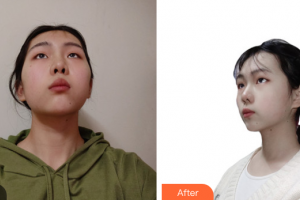 广州博仕整形美容医院青莉整形价格表附光子嫩肤案例展示