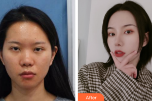 广州南珠医疗美容门诊部黄文博整形价格表附鼻部整形案例展示