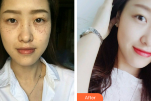广州华美医疗美容医院赖红梅整形价格表附超激光美肤祛斑案例展示