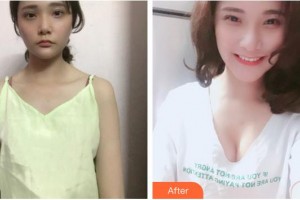 成都美容整形医院赖明忠整形价格表附复合隆胸案例展示