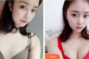 成都医美整形美容医院王显荣整形价格表附浓缩丰胸真实案例展示