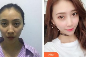 成都艾美薇医疗美容门诊部汪国义整形价格表附自体脂肪填充案例展示