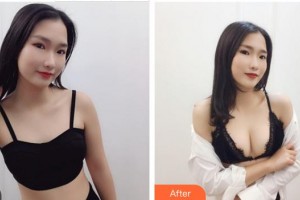 成都华颜医疗美容门诊部王平整形价格表附浓缩丰胸真实案例展示