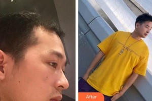 成都风尚格致医学美容整形医院余正伦副教授 整形价格表附发际线案例展示