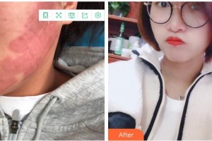 成都美极医疗美容门诊部黄华整形价格表附点阵祛痘坑痘印案例展示
