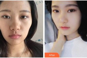 成都艾美医疗美容门诊部蒋学江整形价格表附抗衰老—紧致祛皱—热玛吉案例展示