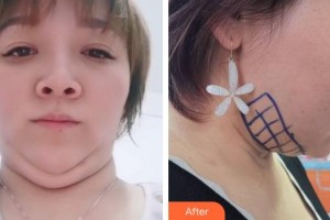 成都风尚格致医学美容整形医院吴冬梅整形价格表附祛双下巴案例展示