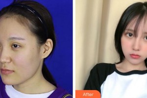 成都华颜医疗美容门诊部王平整形价格表附鼻部手术 面部吸脂案例展示