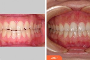 成都瑞森中西医诊所口腔科张宏柱整形价格表附牙齿正畸案例展示