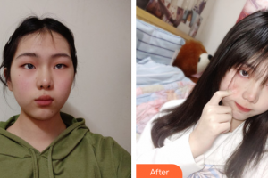 广州肤美美容医院云整形价格表附超激光美肤案例展示