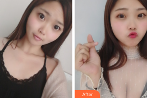 广州美涵医疗整形美容医院张成春整形价格表附自体脂肪隆胸案例展示
