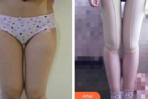 成都唯罗纳医疗美容门诊部李从从整形价格表附吸脂瘦大腿案例展示
