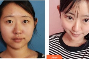 成都度曼美医疗美容诊所奉龙整形价格表附切开双眼皮案例展示