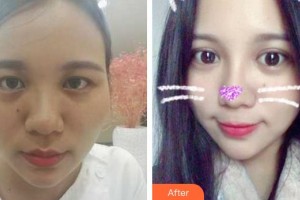 成都臻爱唯美医疗美容医院叶飞轮整形价格表附美眼翘鼻套餐案例展示
