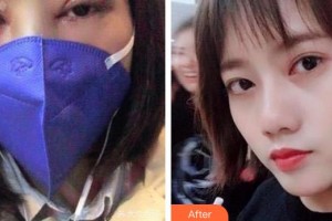 成都爱迪眼科医院文林整形价格表附眼部整形案例展示