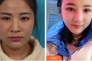 成都中医大银海眼科医院刘小虎整形价格表附眼鼻部手术案例展示