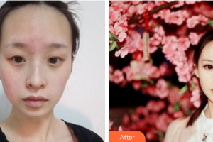 广州韩妃医学美容医院文成浩整形价格表附眼部手术+鼻部手术案例展示
