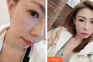 福州格莱美医疗美容医院黄俊俊整形价格表附激光美肤激光案例展示