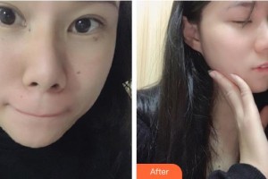 福州爱思特比华利整形美容医院严玉秀整形价格表附双激光美肤案例展示