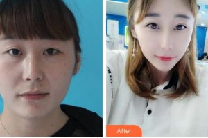 福州东南眼科医院王秉农整形价格表附眼部手术案例展示