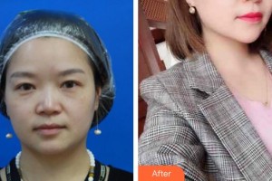 厦门海峡整形美容医院尹卫东整形价格表附鼻部整形案例展示