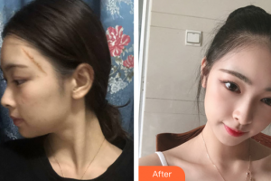 广州中家医家庭医生医学整形美容医院赖峥嵘整形价格表附激光祛疤案例展示
