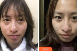 厦门大学附属厦门眼科中心医院修阳晖整形价格表附不开刀去眼袋+泪沟填充案例展示