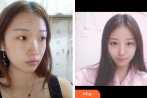 广州中科美整形医院徐长亮整形价格表附祛疤痕案例展示