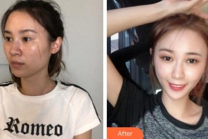 三明万国美莱医疗美容外科门诊部陈垂玉整形价格表附凹陷疤痕案例展示