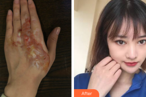 广州瑞港医疗美容门诊部张兆霞整形价格表附烫伤疤痕案例展示