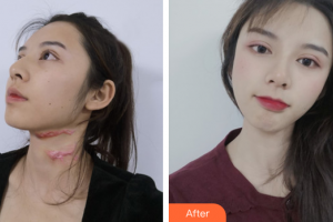 广州瑞港医疗美容门诊部刘衍民整形价格表附微创疤痕修复案例展示