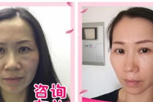 漳州正兴医院医疗美容中心陈红整形价格表附不开刀去眼袋案例展示