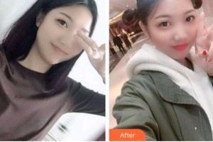 漳州卫生职业学院附属口腔医院吴天昊整形价格表附牙齿根管调节案例展示