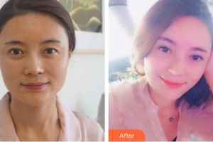安徽立新医学美容门诊部徐商熏整形价格表附半年的韩式全切双眼皮案例展示