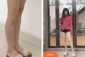 合肥恒美整形医院周铁政整形价格表附增生疤痕案例展示
