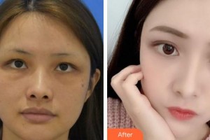 合肥华美整形美容医院梁伟中整形价格表附埋线提升案例展示