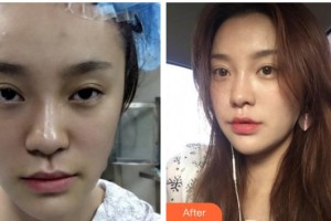 合肥凯美医疗美容医院秦宏智整形价格表附埋线提升案例展示