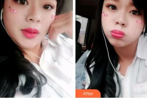 合肥华美整形美容医院支梅整形价格表附牙齿隐形矫正案例展示