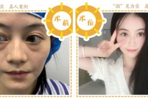 合肥华美整形美容医院秦兴利整形价格表附埋线提升案例展示