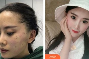 合肥丽人女子医院中韩整形美容中心朴洪龙整形价格表附面部埋线提升案例展示