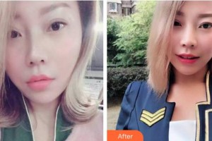 合肥爱春整形美容医院范爱春整形价格表附牙齿隐形矫正案例展示