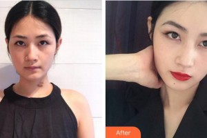 合肥申诚整形美容医院卢杰整形价格表附疤痕案例展示