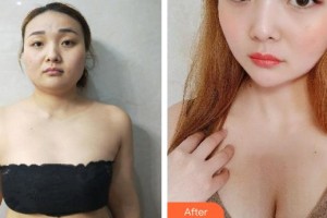 合肥福华医疗美容医院龚细平整形价格表附自体脂肪隆胸案例展示