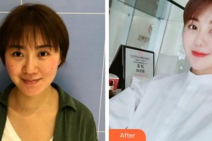 合肥台美医疗美容门诊部陈宏荣整形价格表附埋线提升案例展示