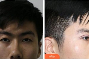 合肥爱尔眼科医院李萍整形价格表附埋线双眼皮案例展示