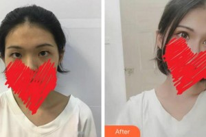 淮南泽明眼科医院（原淮南东方医院集团眼科医院）陈蓓莉整形价格表附切开双眼皮】案例展示