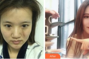 安庆亚星医疗美容门诊部刘佩欣整形价格表附祛疤案例展示