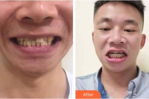 亳州郭琳口腔诊所肖明慧整形价格表附牙齿隐形矫正案例展示