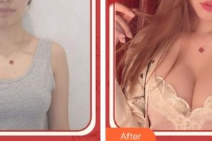 浙江省人民医院整形外科郭金才整形价格表附自体脂肪隆胸案例展示